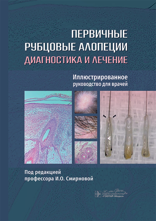 Первичные рубцовые алопеции. Диагностика и лечение. Иллюстрированное руководство для врачей