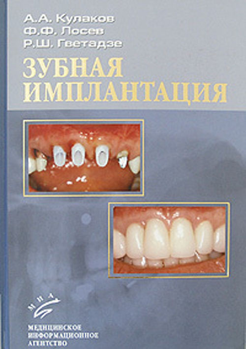 Зубная имплантация